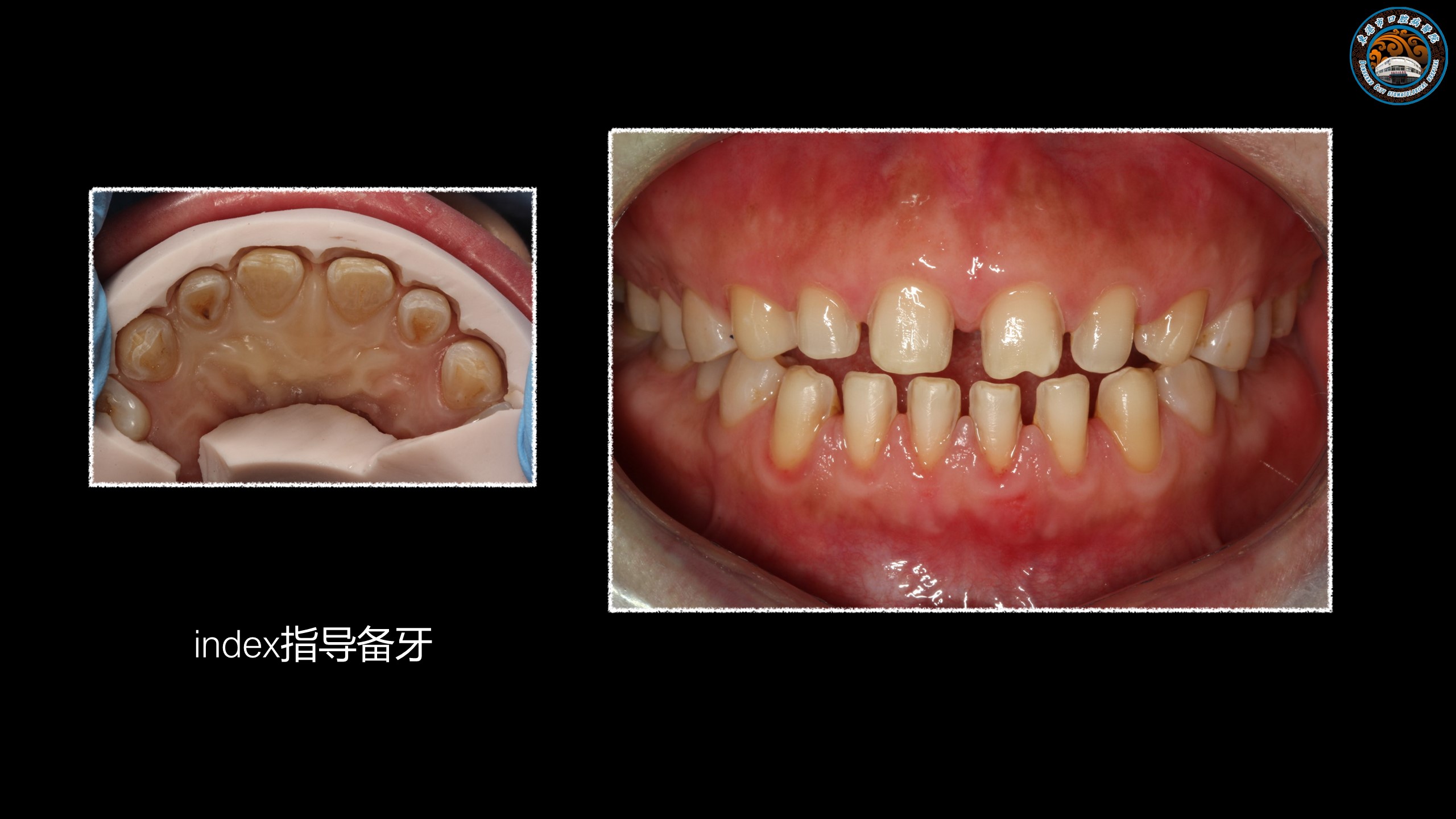 美学案例分享|全瓷贴面关闭前牙间隙一例